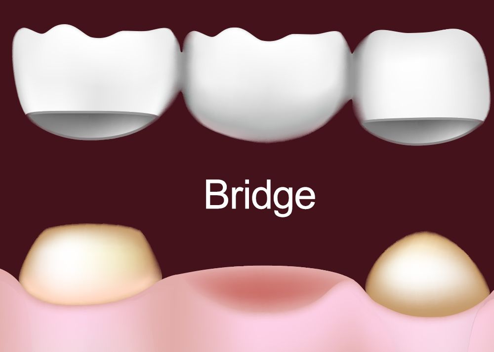 Illustration of dental bridge above a missing tooth