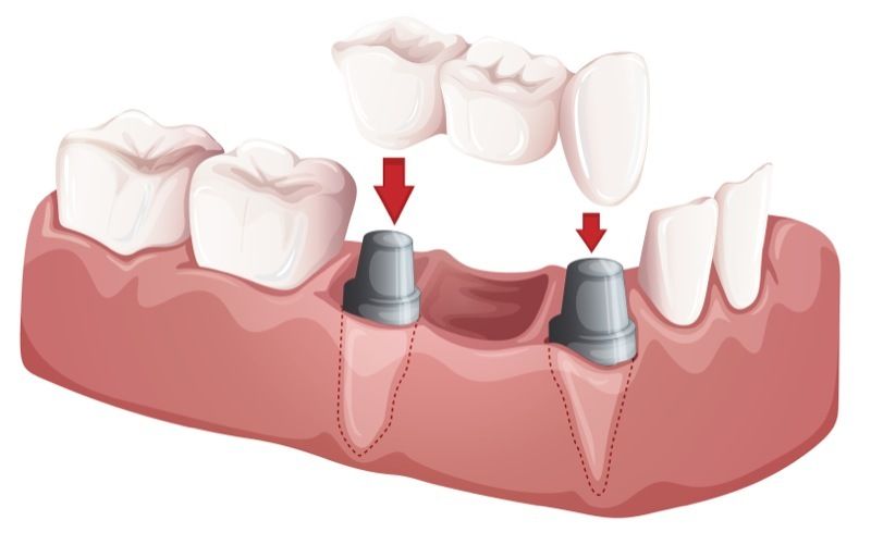 Implant-supported bridges