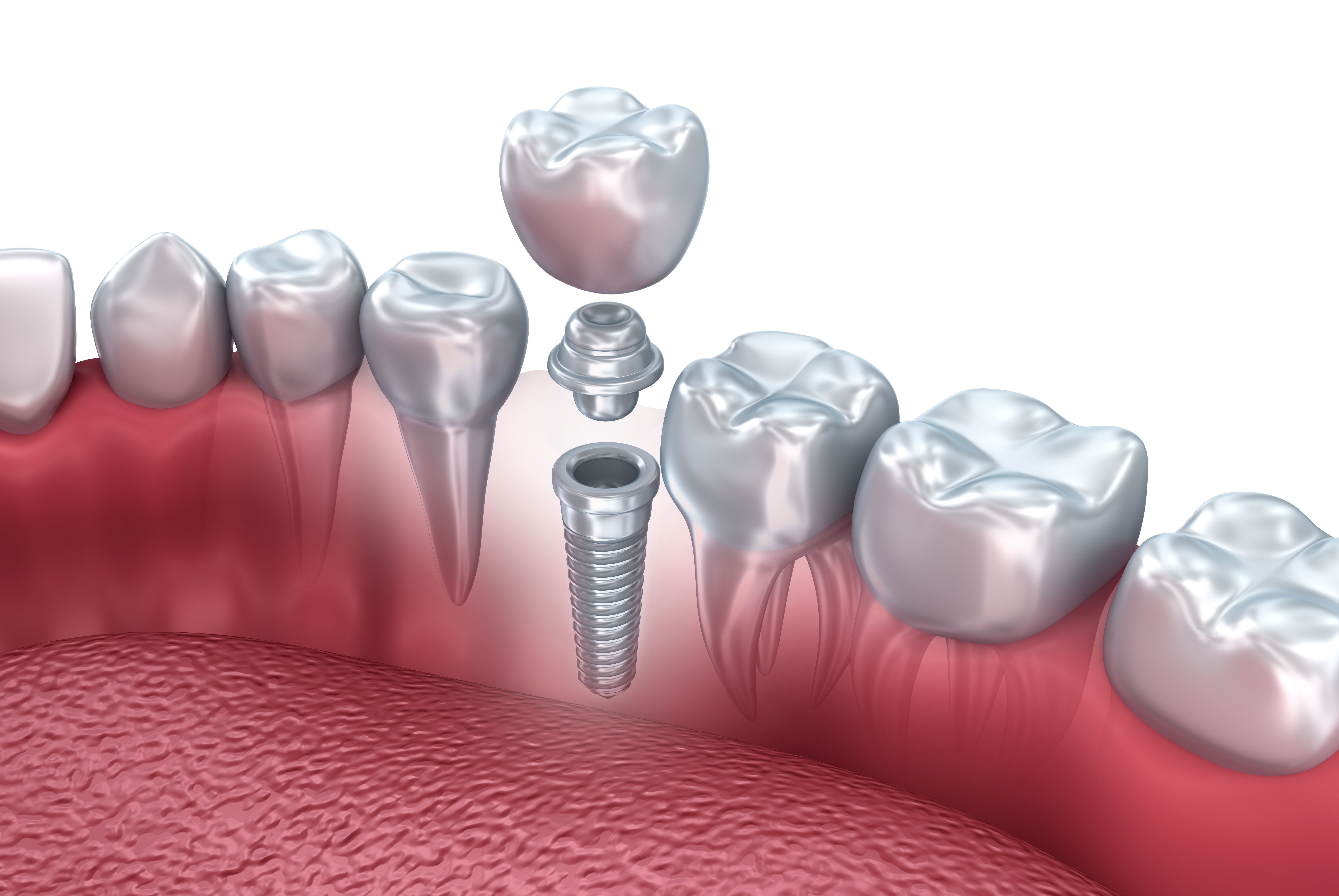 single-tooth implant