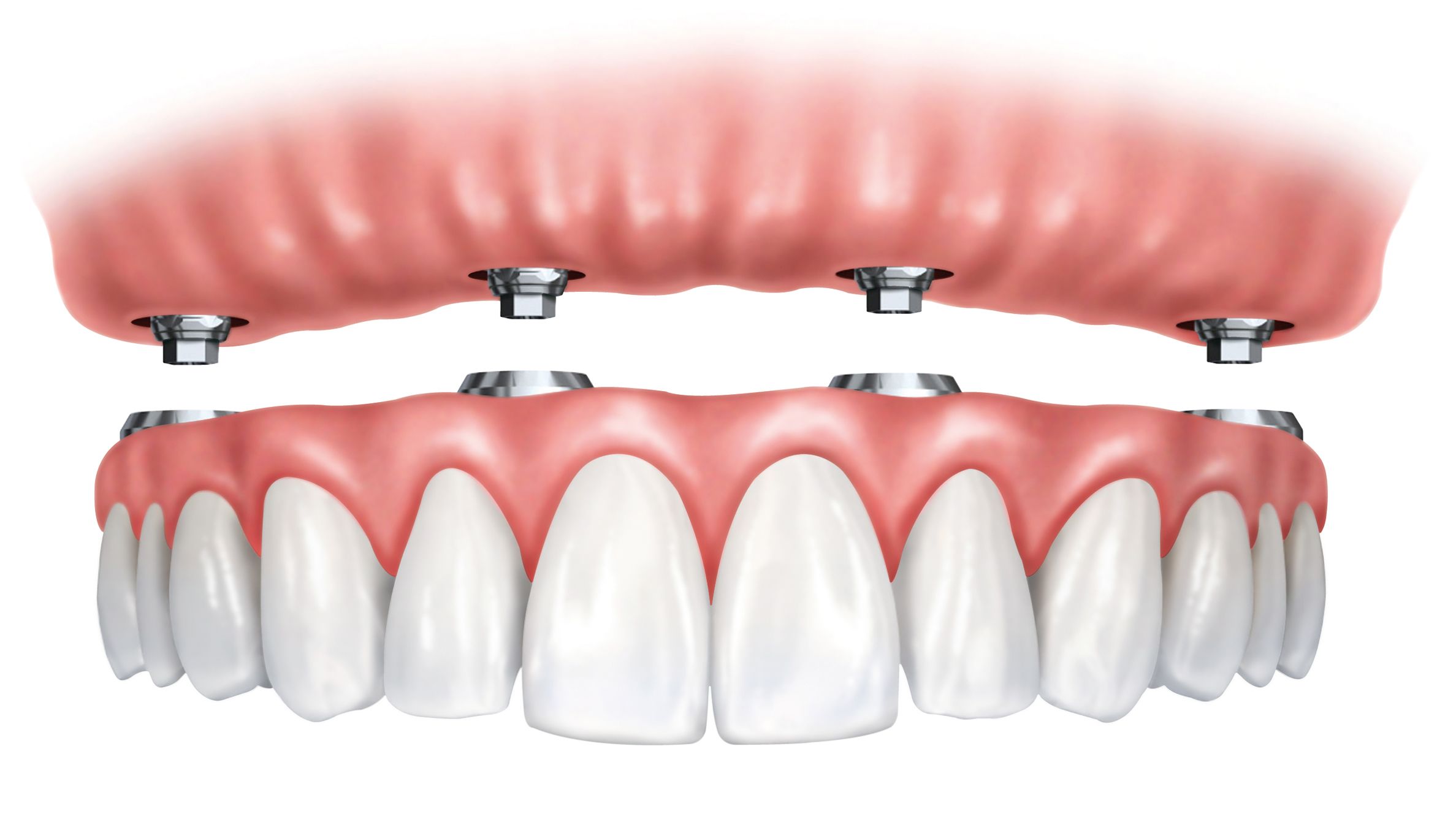 Implant-supported dentures