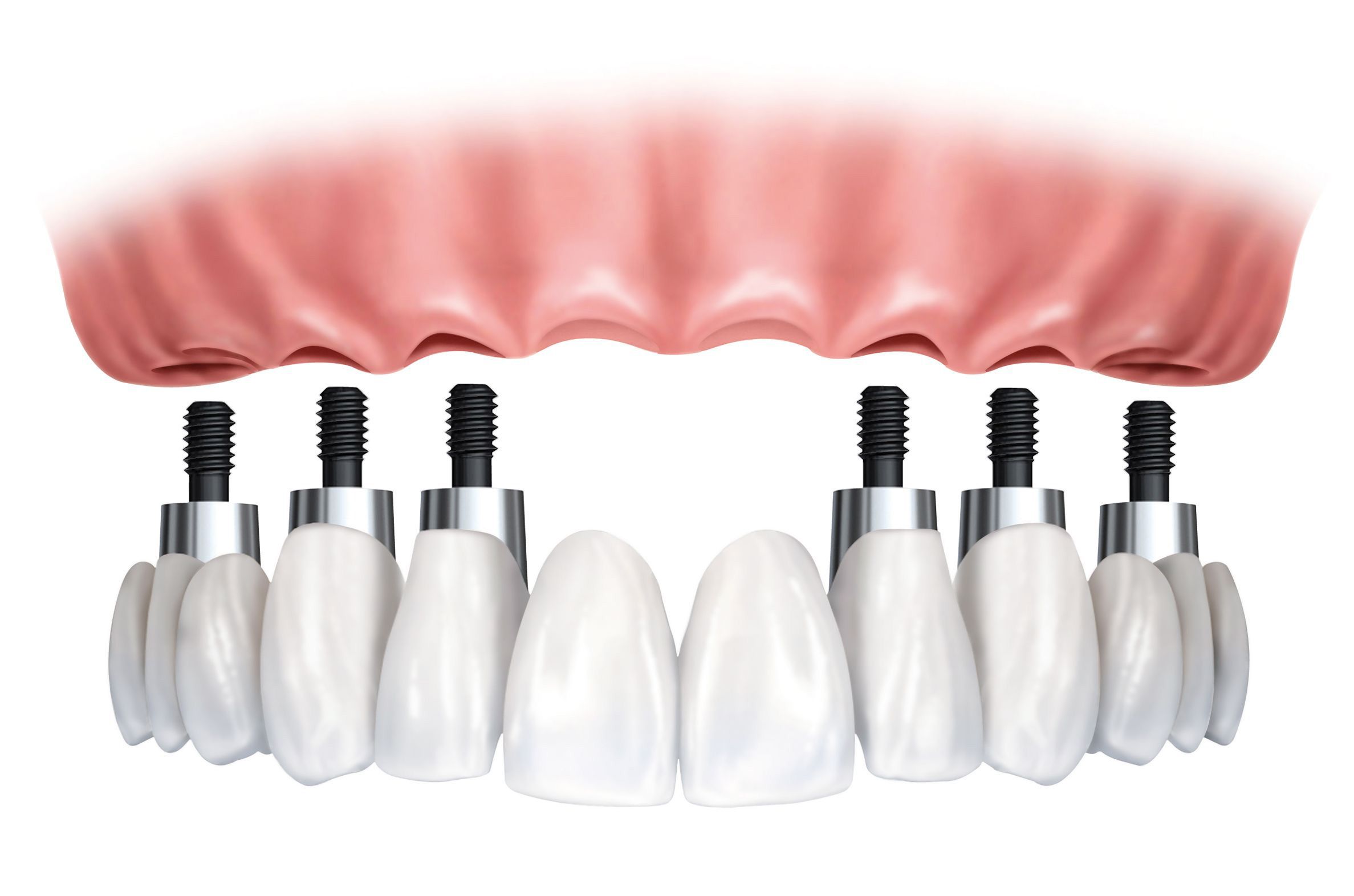 Denture attached to upper jaw with six implants