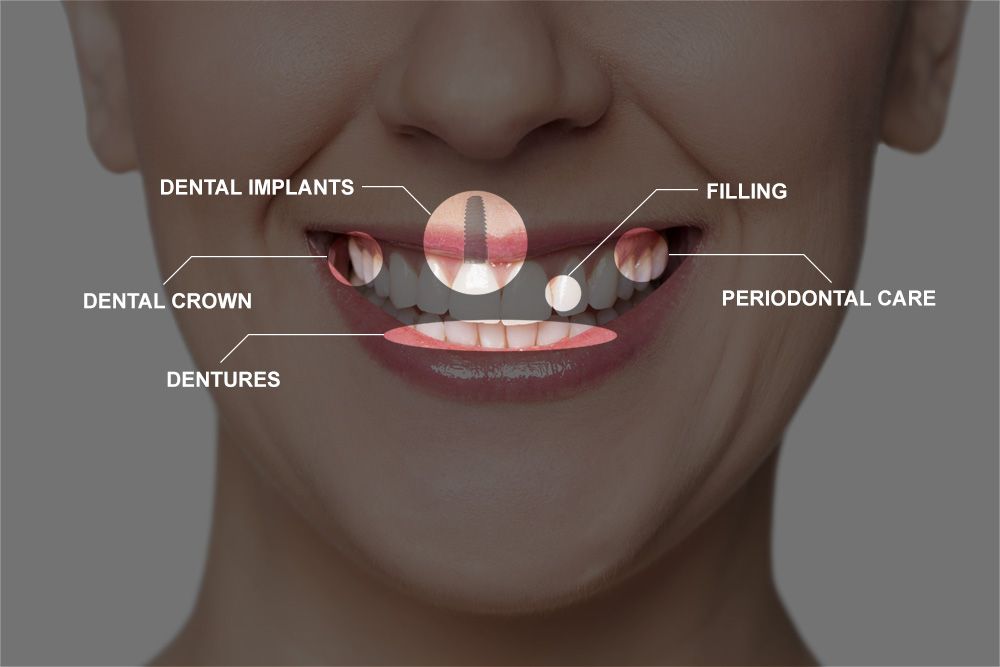 Woman's mouth with examples of full mouth reconstruction procedures