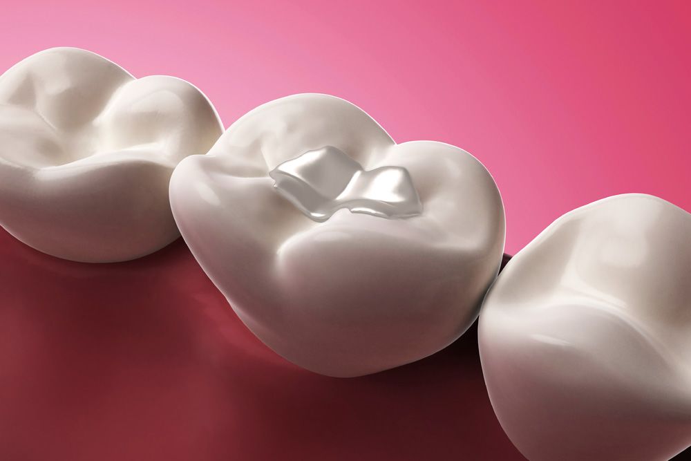 Illustration of tooth-colored filling