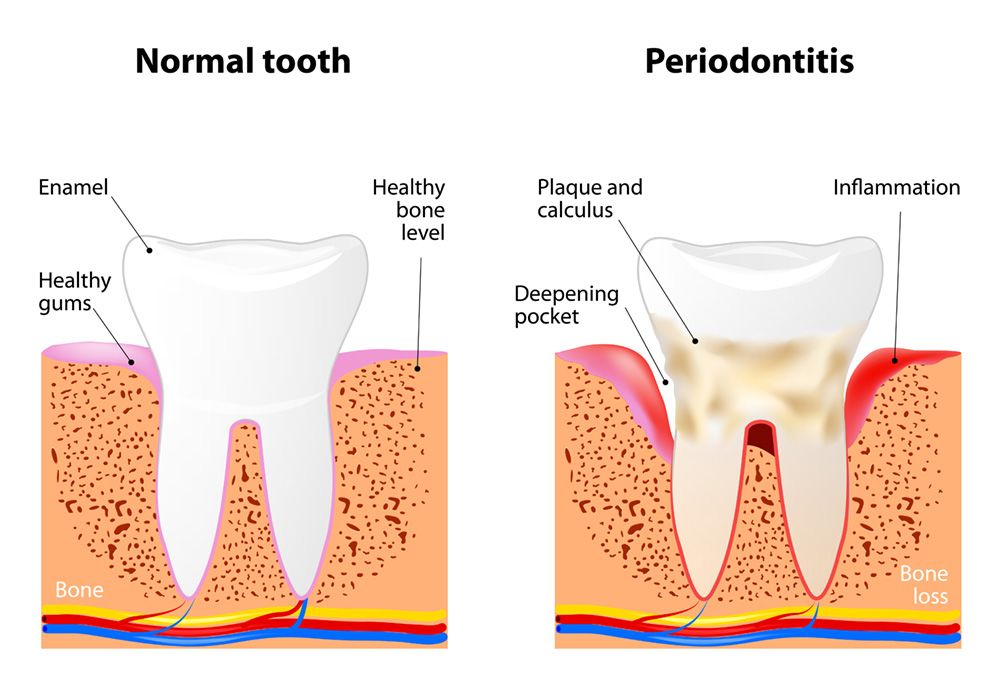 Illustration of a normal, healthy tooth and a tooth with periodontitis.