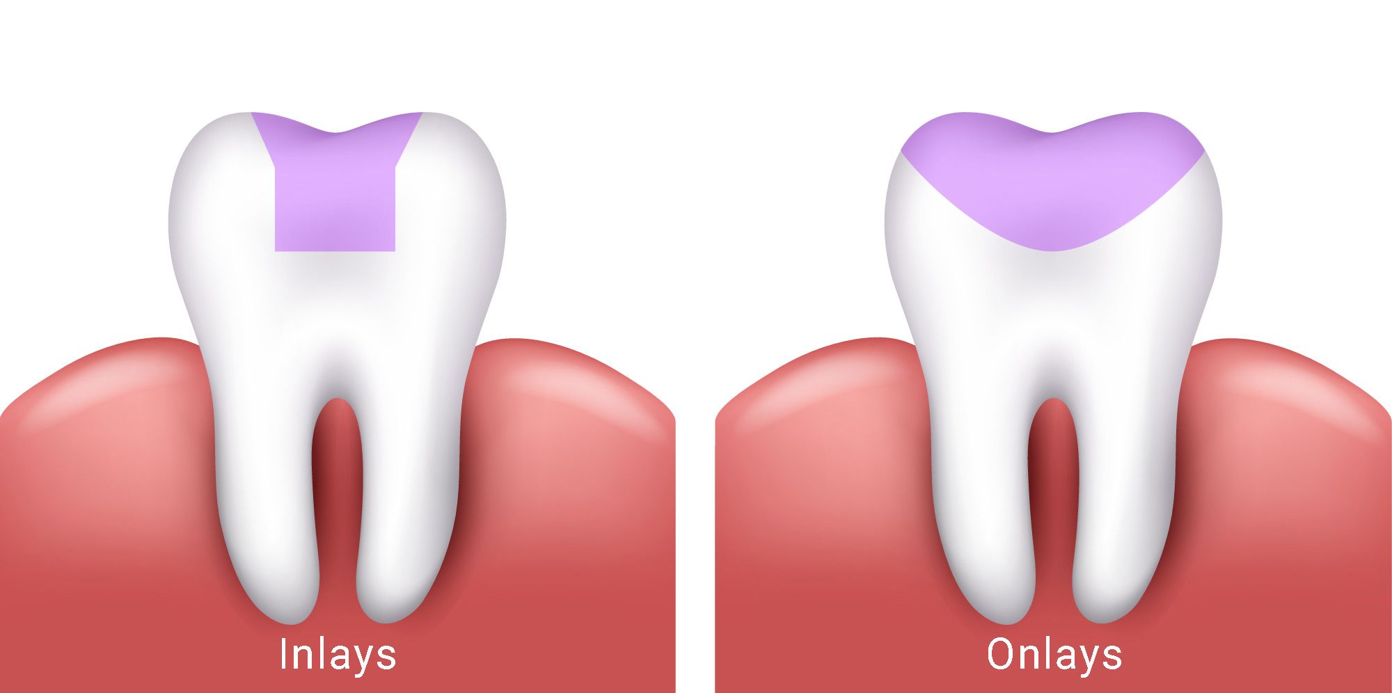 Illustration of inlay and onlay