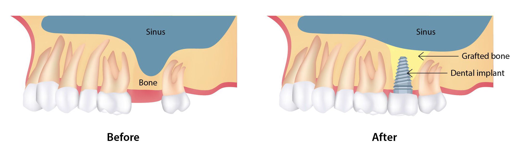 Sinus lift procedure